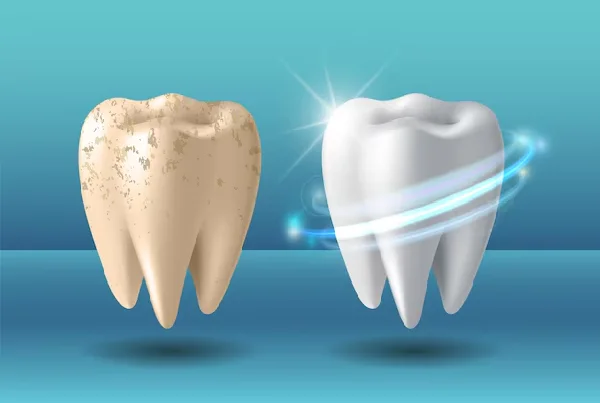 Teeth Whitening and Bleaching