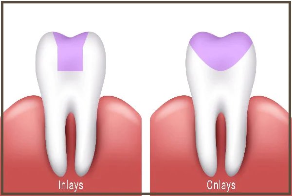 Inlays and Onlays Dental