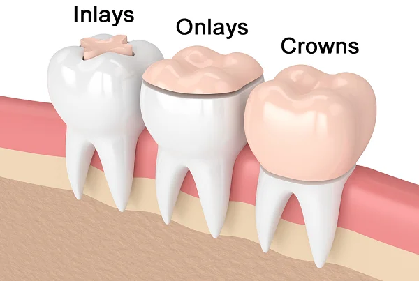 Crowns Inlays and Onlays